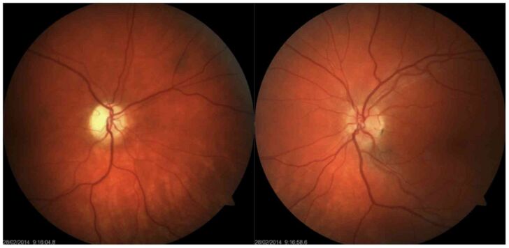Traumatic Optic Neuropathy[2]