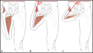 Very short trans-femoral stumps often end up in abduction because there is an imbalance between the adductor and abductor muscles.