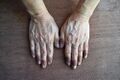 Cyanotic colouration of the fingers