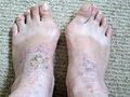 Hallux valgus