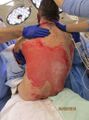 Example of wound prior to infection