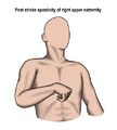 Flexor spasticity pattern of the upper extremity