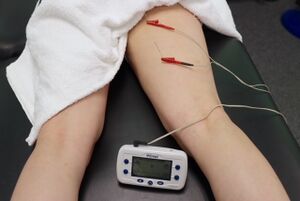 A patient lying prone, visible from the waist to mid-calf, with a towel covering the buttocks and part of the left leg. Two needles are inserted cranially and distally into the belly of the right semitendinosus muscle, connected via crocodile clips to a small white electrical stimulation device, demonstrating electrical dry needling technique on the hamstring muscles.