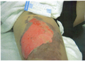 Superficial burn wound