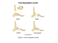 Midfoot/hindfoot amputation levels