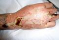 Example of wound after desiccation