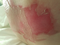 Pseudo-eschar formation over burn wound bed