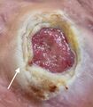 White arrow indicates area of maceration in periwound