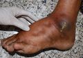 Pitting oedema