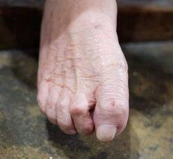 Claw toe