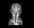 Example of Magnetic Resonance Angiography