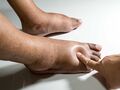 Pitting oedema