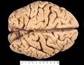 Note the raised gyri and depressed sulci forming the surface of the cerebrum