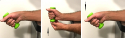 Eccentric wrist radial deviation