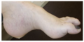 Hammer toe with high foot arch