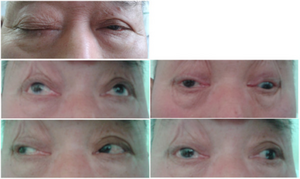 Available from:http://openi.nlm.nih.gov/detailedresult.php?img=3996493_1129-2377-15-19-1&query=Oculomotor%20nerve%20palsy&it=xg&lic=by&req=4&npos=4