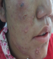 Skin lesions on the face