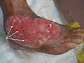 White arrows point to examples of hypergranulation tissue.