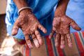 Trophic changes of the hands