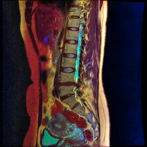 MRI
