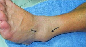 Image showing swollen sprained left ankle