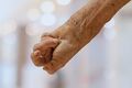 Severe hand contracture related to leprosy