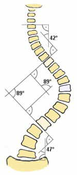 Cobb angle illustration