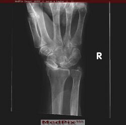 Special Radiographic Views for Scapholunate Dissociation: Clenched Fist