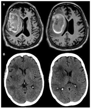 Two brain scan images, A and B, each showing a right-hemisphere brain lesion.