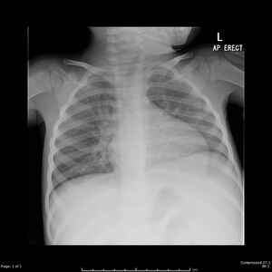 Case courtesy of Candice Norris, Radiopaedia.org, rID: 50955