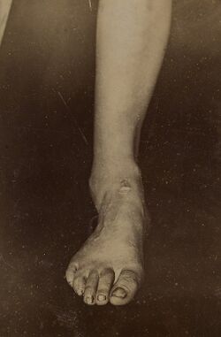 Credit: L0066989 Badly united Pott's fracture. 4 May 1896 By: St Bartholomew's Hospital Photographic Society. St Bartholomew's Hospital Archives & Museum, Wellcome Images. Wellcome Images images@wellcome.ac.uk http://wellcomeimages.org St Bartholomew's Hospital Archives & Museum