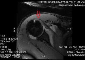 https://commons.wikimedia.org/wiki/File:MRI._Partial_rupture_of_the_cranial_subscapularis_tendon_at_the_insertion_site..jpg