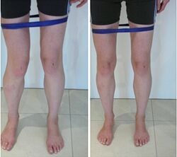 External Rotation of the Hip in Standing