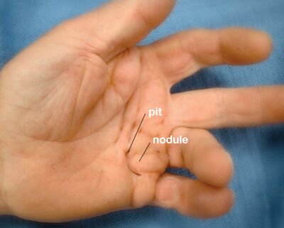 Image 3: Skin pitting and the presence of nodules in Dupuytren disease
