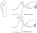 Babinski reflex and positive result (ie. Babinski sign)
