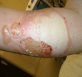 Full thickness burn wound