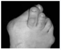 Cross-over toe with bunion