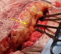 Yellow arrow indicates fat.