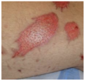 Red skin demonstrates re-epitheliasation. Please note the small raised hair follicles in the area of re-epithelialisation.