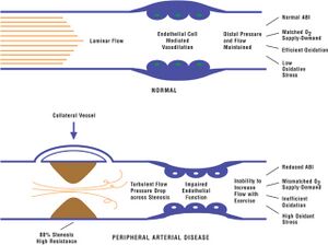 Narrowing of artery