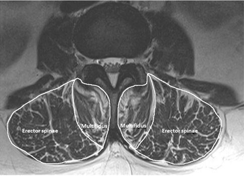 An example of high fat (50%) content of multifidus