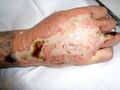 Eschar formation over burn wound on hand
