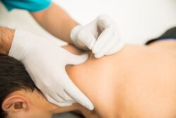 Dry needling applied to the upper back in a clinical setting.