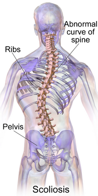 scoliosis clinical presentation
