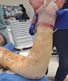 Full thickness burn wound