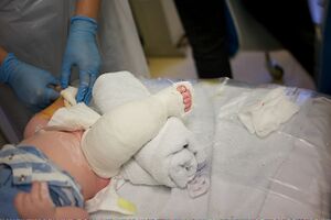 Nate at the Chelsea & Westminster Hospital Ponseti clinic - tenotomy procedure