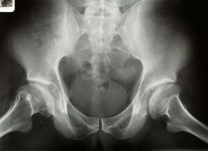 XRay - Bilateral Avascular Necrosis Femoral Head (Legg Calve Perthes Disease)