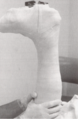 Total contact cast (TCC)