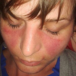This image illustrates the typical distribution pattern of the butterfly (malar) rash that can be a characteristic of SLE. This picture was included courtesy of: http://images.google.com.