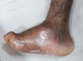 Charcot foot